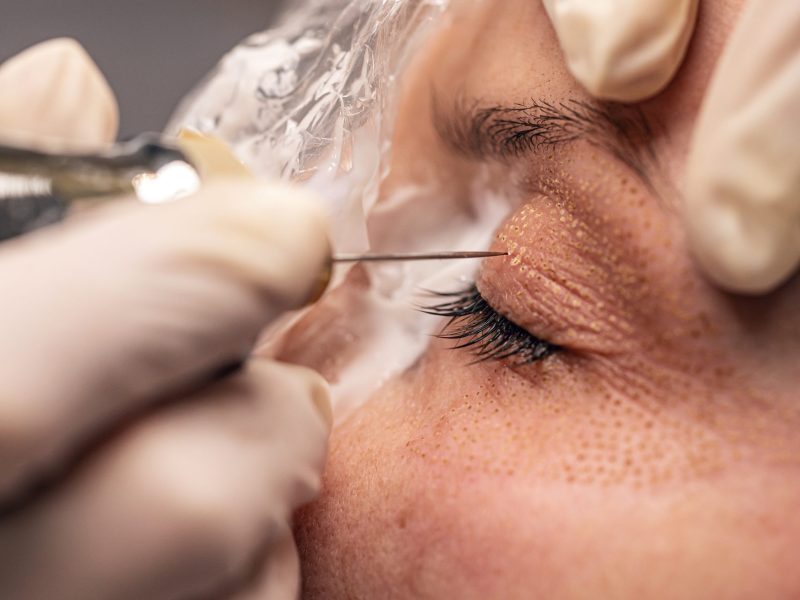Fibroblast, plasmalifting procedure woman eyelid wrinkles lifting